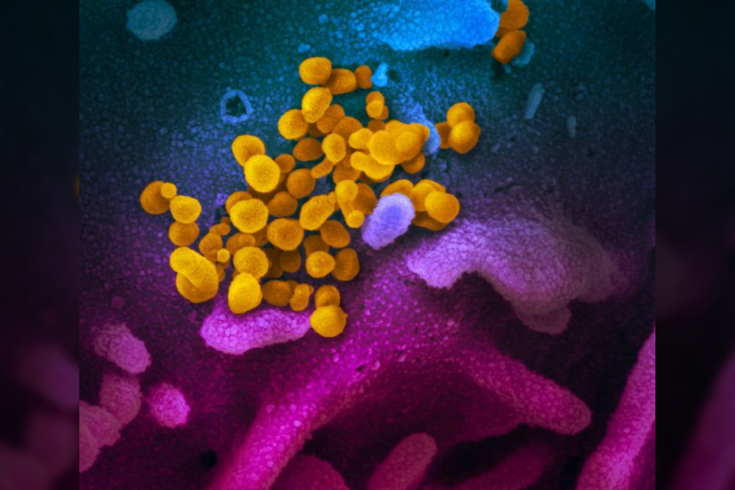  Šis skenuojančiojo elektroninio mikroskopo vaizdas rodo naują koronavirusą (geltona spalva) tarp žmogaus ląstelių (mėlyną, purpurinė ir violetinės spalvos). Vaizdas buvo papildytas spalvomis, kad būtų lengviau atskirti virusą ir jo aplinką.<br> NIAID-RML nuotr.