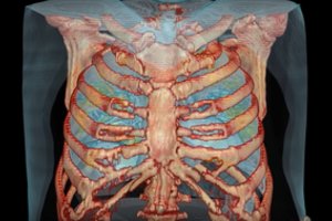 Parodė, kaip koronavirusas pažeidė 59 metų vyro plaučius: tai labai rimta