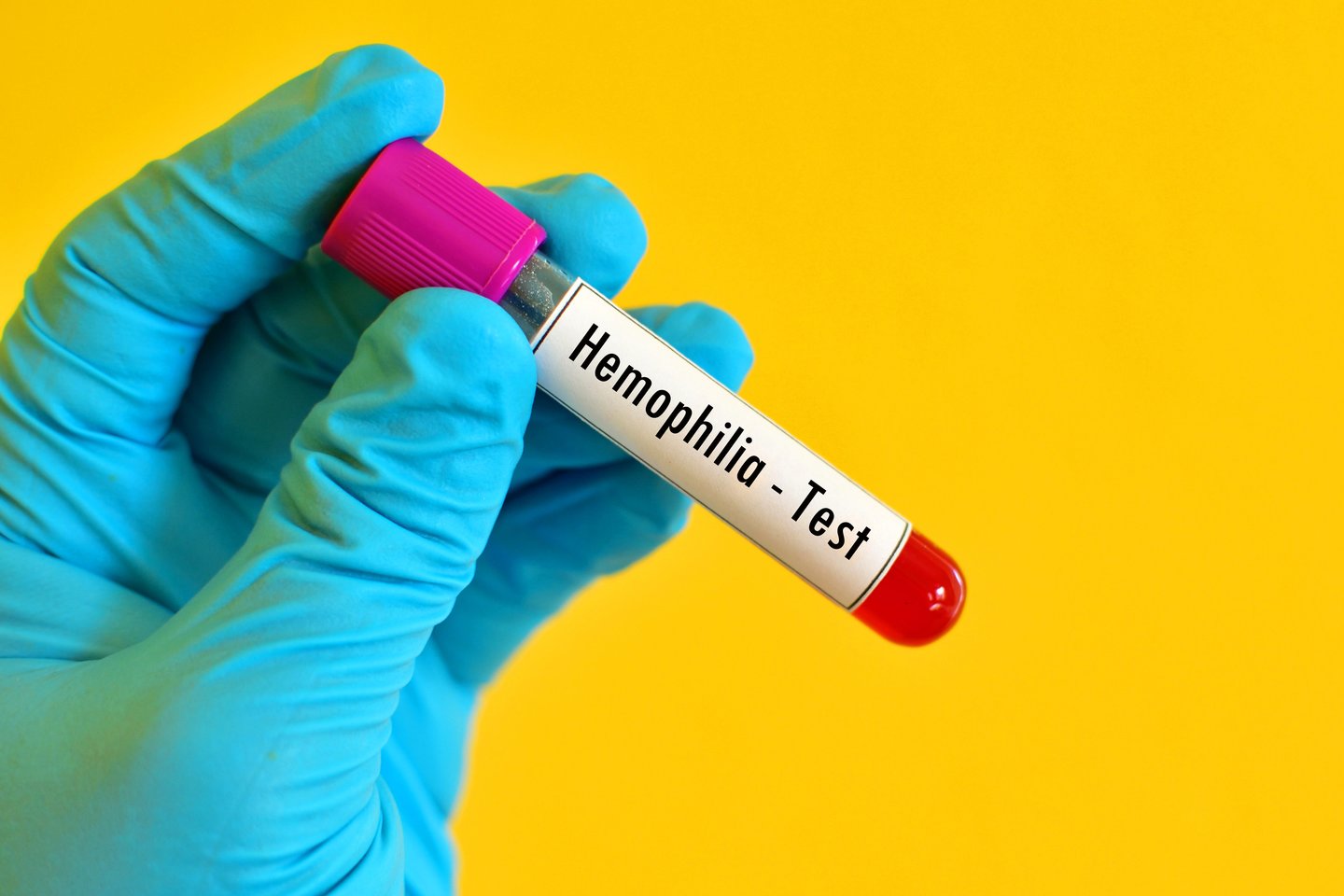 Hemofilija – tai sutrikusio kraujo krešėjimo liga.<br>123rf nuotr.