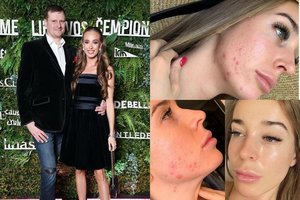 Apie odos problemas prakalbusi Viktorija Siegel parodė savo veidą: „Kartais sulaukdavau patyčių“