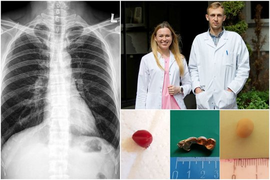 Klaipėdos medikus apstulbino radinys paciento bronchuose: aptiko auksinius dantis