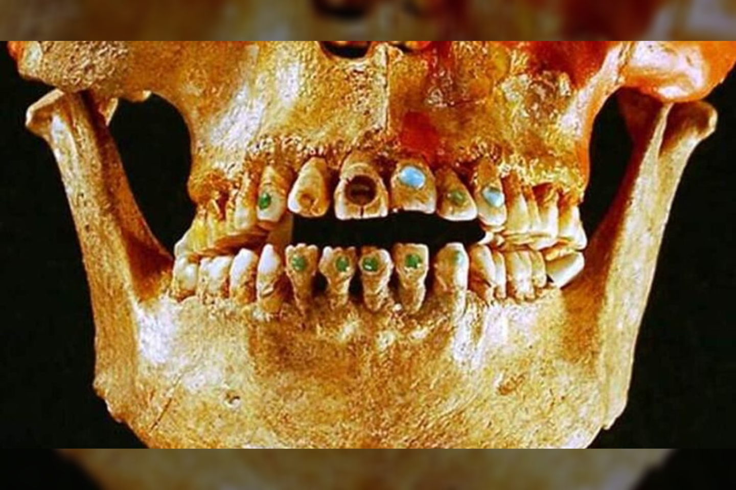  Į moters į viršutinius priekinius dantis buvo buvo įspausti du apvalūs pirito akmenys. Tokia praktika buvo populiari tarp didikų pietinėje Meksikoje ir Centrinėje Amerikoje.<br> „Archeology Today“ nuotr.