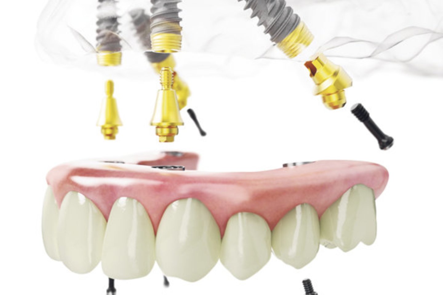 Gydymo metodika „visi ant keturių“ leidžia visus vieno žandikaulio dantis atkurti tik ant 4 implantų.<br> Partnerio nuotr.