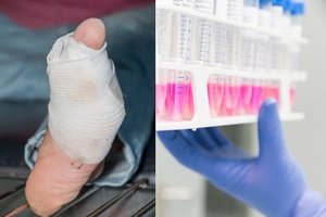 Dėl COVID-19 testo vilniečiui teko atidėti amputaciją: gydytojai prisipažino, kad jaučiasi bejėgiai