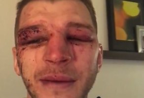 Po smūgių krušos UFC kovą pralaimėjęs D. Hookeris parodė kas liko iš veido