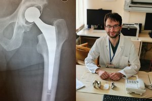 Laukiantiems sąnario protezavimo – nemokama greitesnė alternatyva