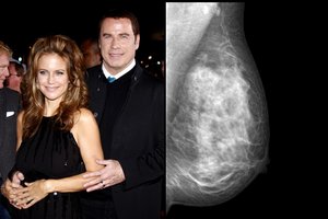 Populiari aktorė pralaimėjo kovą: ką būtina žinoti apie krūties vėžį