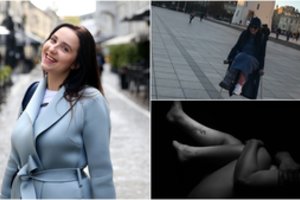 Vilnietės aktorės siaubas: po nelemto įvykio kojoje liko duobė