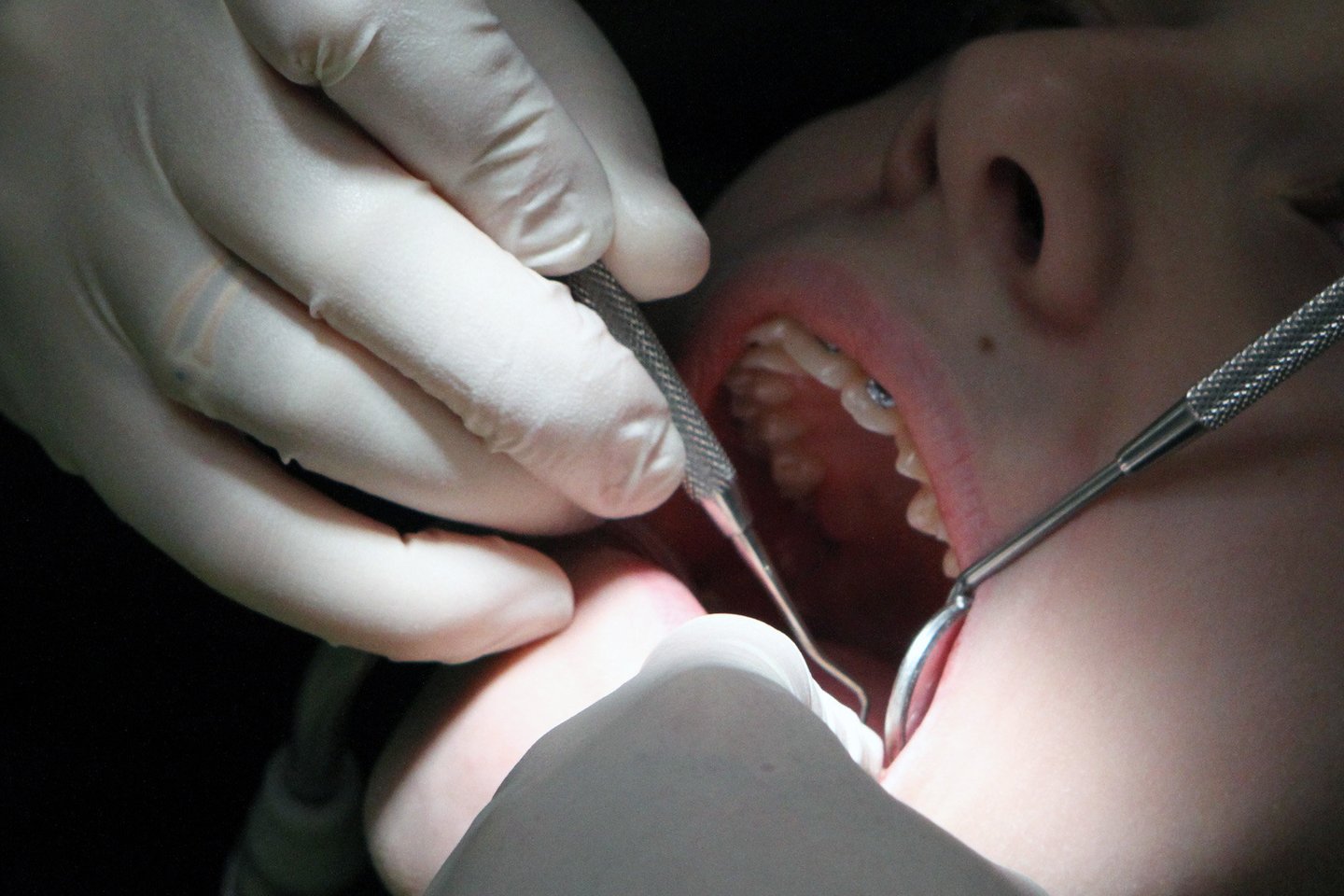 Patyrus danties traumą reikėtų kuo skubiau apsilankyti pas odontologą.<br>M.Patašiaus nuotr.