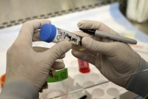 Mokslininkai atrado žmogaus imuninę ląstelę, kuri nužudo daugelį vėžio formų