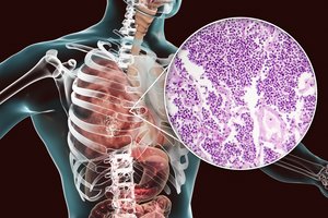 Specialistai paragino skiepytis nuo pneumokokinės ir meningokokinės infekcijų: skiepai aktualesni nei bet kada