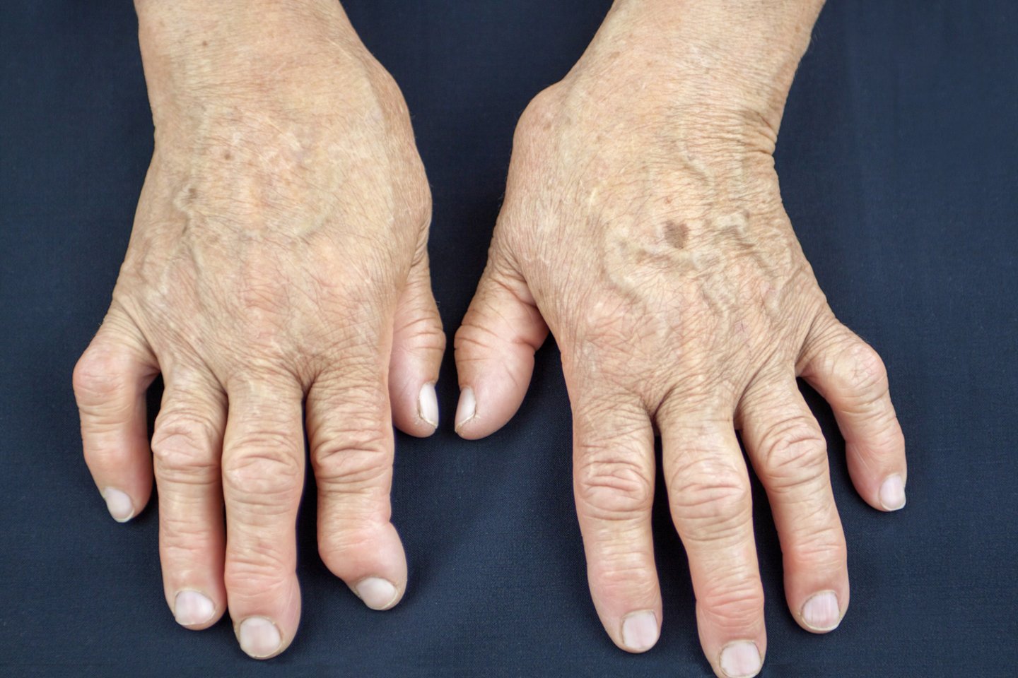 Visame pasaulyje milijonai žmonių serga artritu, jų gyvenimas dažnai būna paženklintas nuolatinio sąnarių skausmo ir uždegimo.  <br>123rf nuotr.