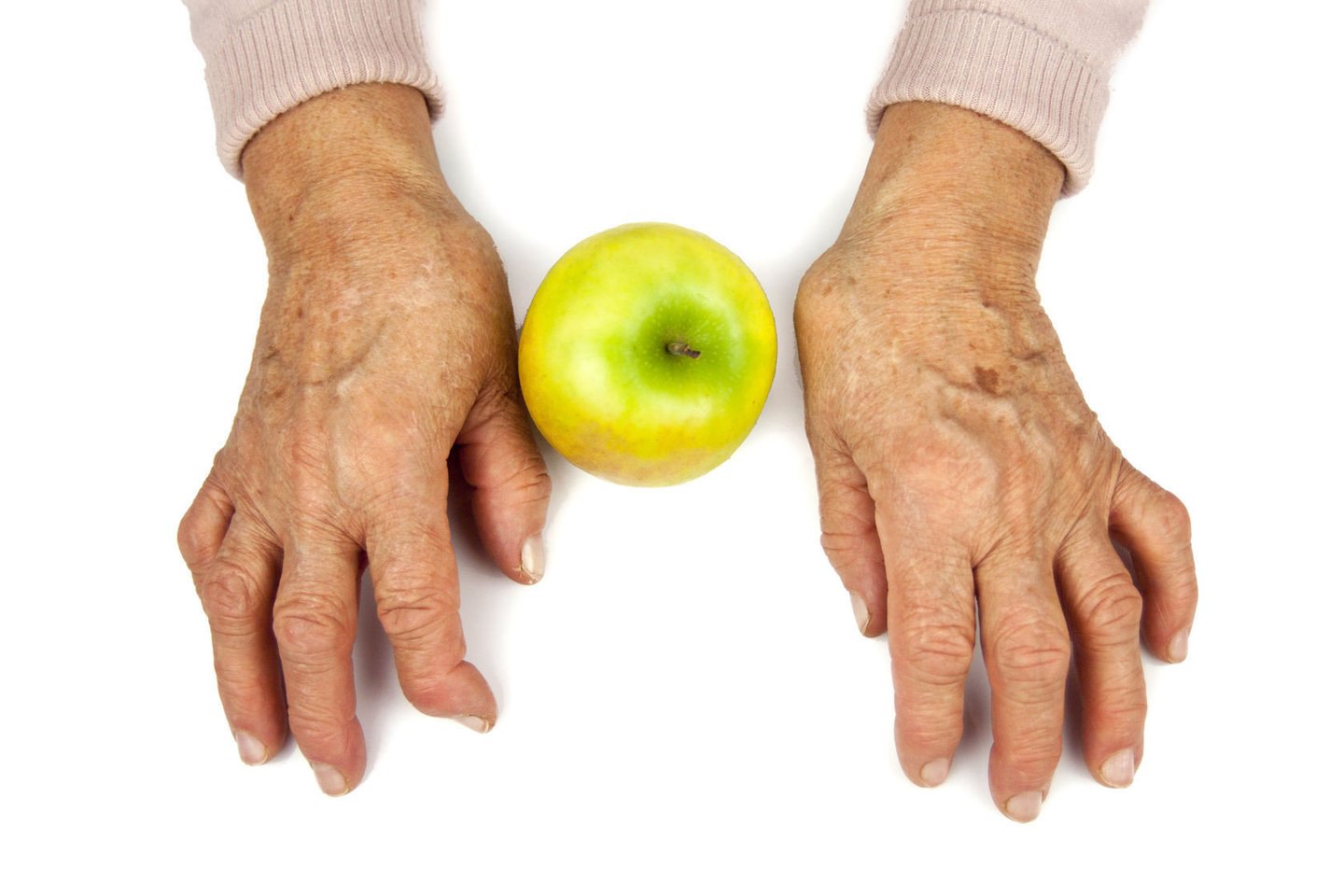 Visame pasaulyje milijonai žmonių serga artritu, jų gyvenimas dažnai būna paženklintas nuolatinio sąnarių skausmo ir uždegimo.  <br>123rf.com
