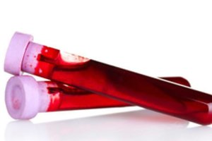 Aurimą sugniuždė kraujo vėžio diagnozė: dabar jis juokiasi iš ankstesnio gyvenimo problemų