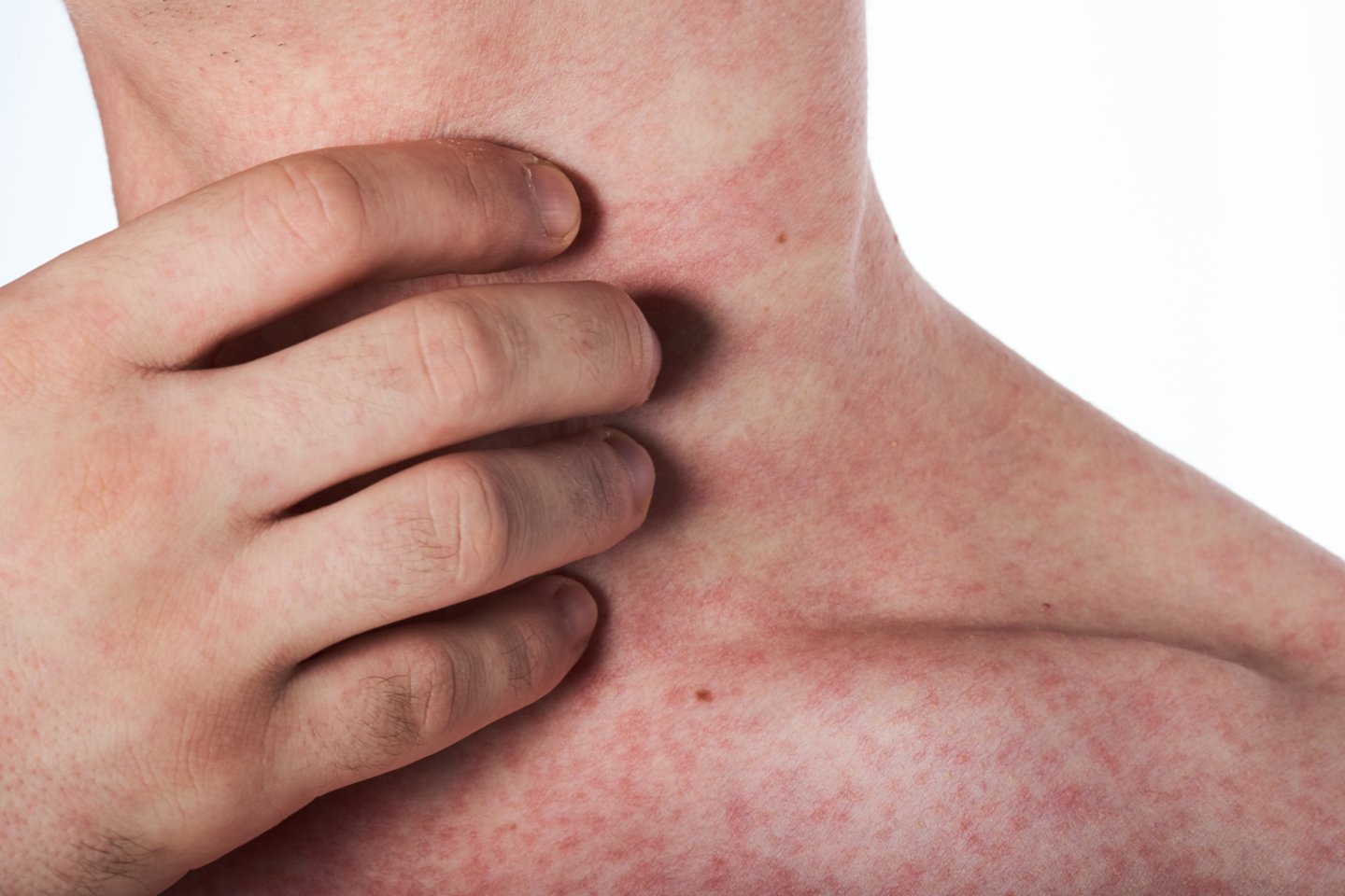 Gydytoja alergologė-klinikinė imunologė įspėja, jog nusilpusią imuninę sistemą gali išduoti pakitusi odos būklė.<br>123rf nuotr.