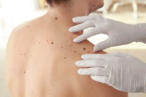 Lietuvių sukurtas naujas neinvazinis metodas tiksliai diagnozuoja melanomą