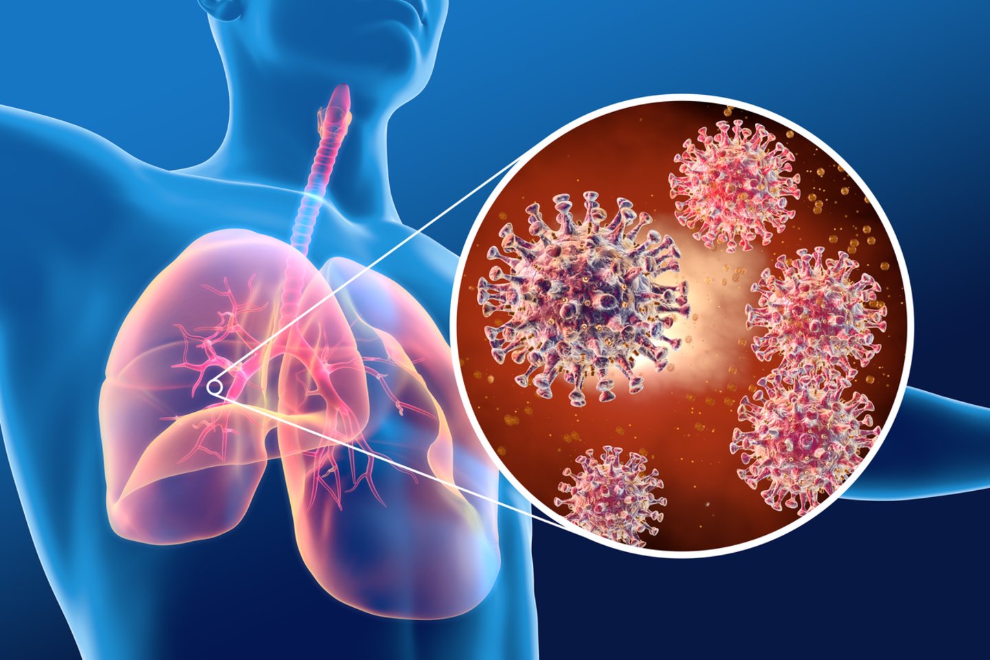  Naujame tyrime JAV sveikatos apsaugos paslaugų tinklo „Northwestern Medicine“ tyrėjai nurodo, kad COVID-19 sukeliamas plaučių uždegimas yra stipriai kitoks.<br> 123rf iliustr.