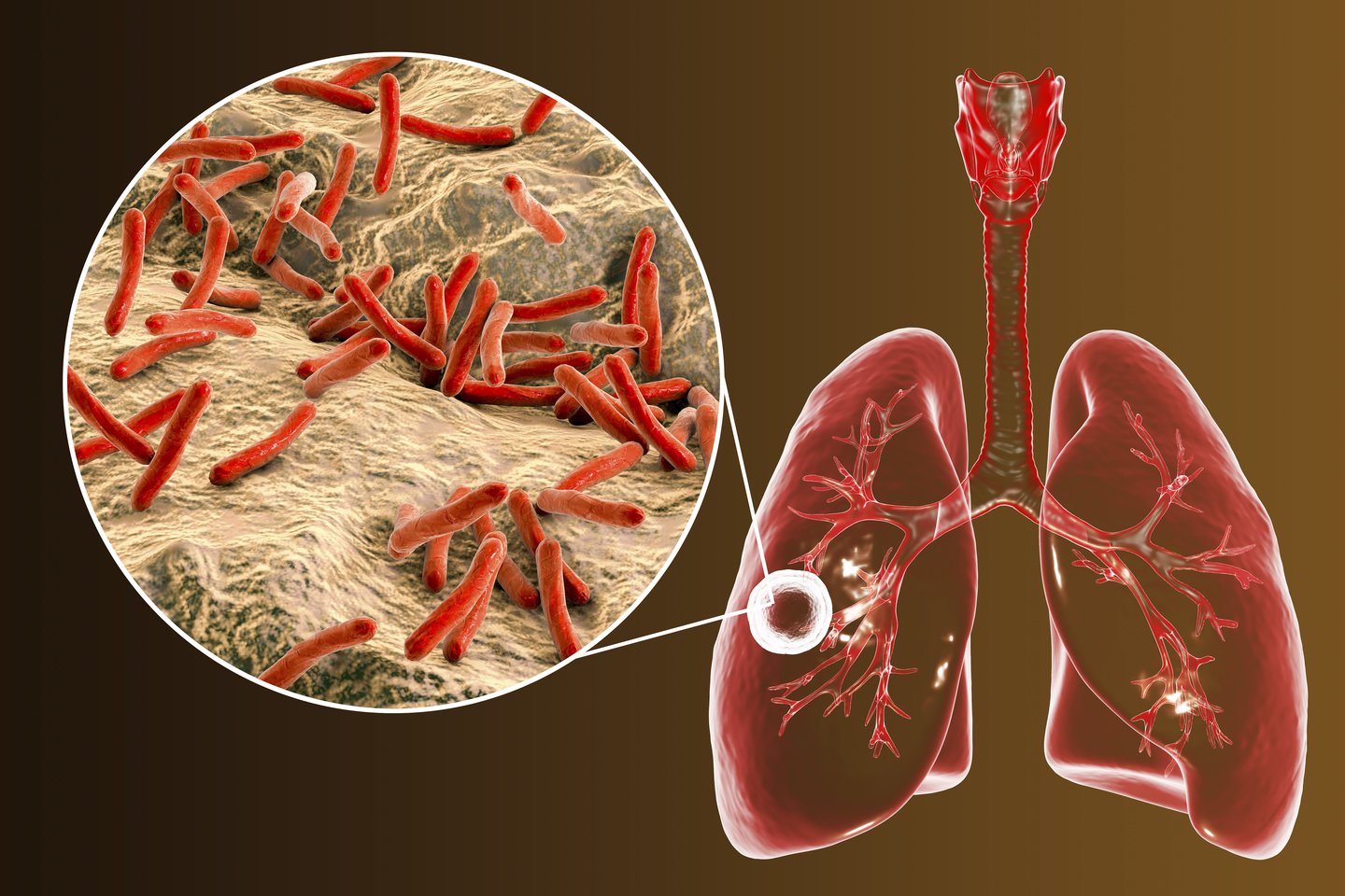 Pasauliui kovojant su koronaviruso infekcija, nepaliaujamai daugėja ir plaučių uždegimo atvejų.<br>123rf iliustr.