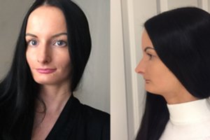 Dėl savo išvaizdos kompleksuojanti ukmergiškė: „Man padės tik sudėtinga operacija“