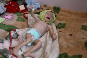JT: Jemene maždaug pusė vaikų iki penkerių metų susiduria su ūminiu neprievalgiu