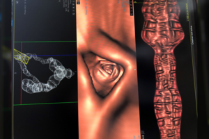 Naujas įrankis kovoje su klastinga liga: padeda net išskirtiniais atvejais