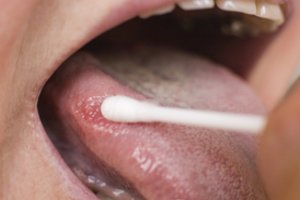 Burnos vėžys: retas, bet mirtinai pavojingas: kviečia tikrintis nemokamai