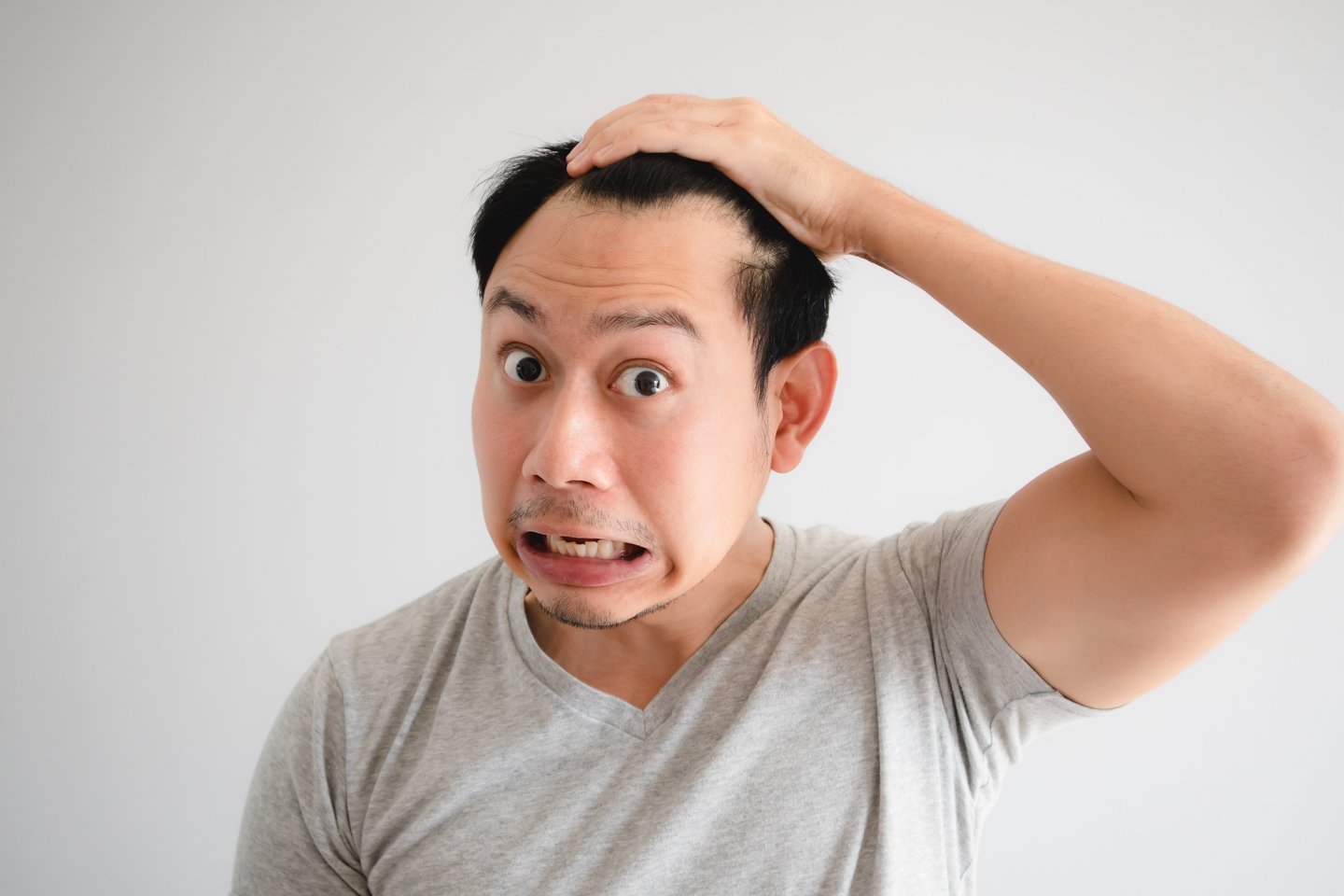 Vis daugiau atsiranda duomenų ir apie dažnėjantį ryškų plaukų slinkimą arba netekimą tarp žmonių, persirgusių COVID–19. <br> 123rf.com nuotr.