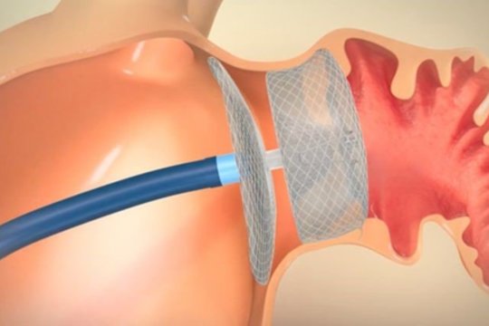 Gydytojai džiaugiasi: naujos technologijos leidžia operuoti širdį stebint trimatėje erdvėje