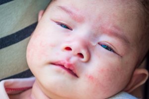 Gydytoja alergologė paaiškino, kada vaikų bėrimas yra atopinis dermatitas