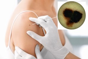 Agresyviausias odos vėžys neskauda, o progresuoti gali ir per mėnesį: kviečia nemokamai pasitikrinti