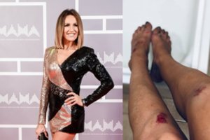 K. Zvonkuvienė koncerto metu nukrito nuo scenos, bet tęsė pasirodymą