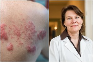 Su nekalta infekcija painiojama liga – mirtinas pavojus, kurio galima išvengti