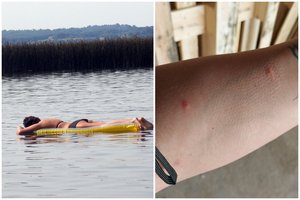 Įspėja poilsiautojus: maudynės Dzūkijos ežere baigėsi bėrimais ir niežuliu