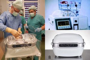 Brangi, bet paciento sveikatai palanki technologija padeda išsaugoti donorinį inkstą