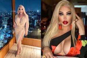 Gyva lėlė J. Alves ryžosi sudėtingai operacijai: kaina siekia daugiau nei 34 tūkst. eurų