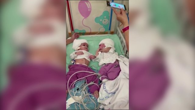 Unikali operacija Izraelyje: sėkmingai atskirtos pakaušiais suaugusios Siamo dvynės