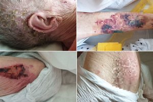 Motiną iš slaugos ligoninės parsivežęs šiaulietis nustėro iš siaubo: kūną buvo nusėjusios kruvinos opos