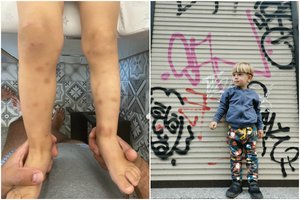 Trimetis Jokūbas serga sunkia paveldima liga: susirgimą išdavė berniuko kojos