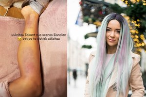 Nukritusi nuo scenos Monika Šalčiūtė patyrė rimtą traumą: skauda, tačiau šoks ir šiandien