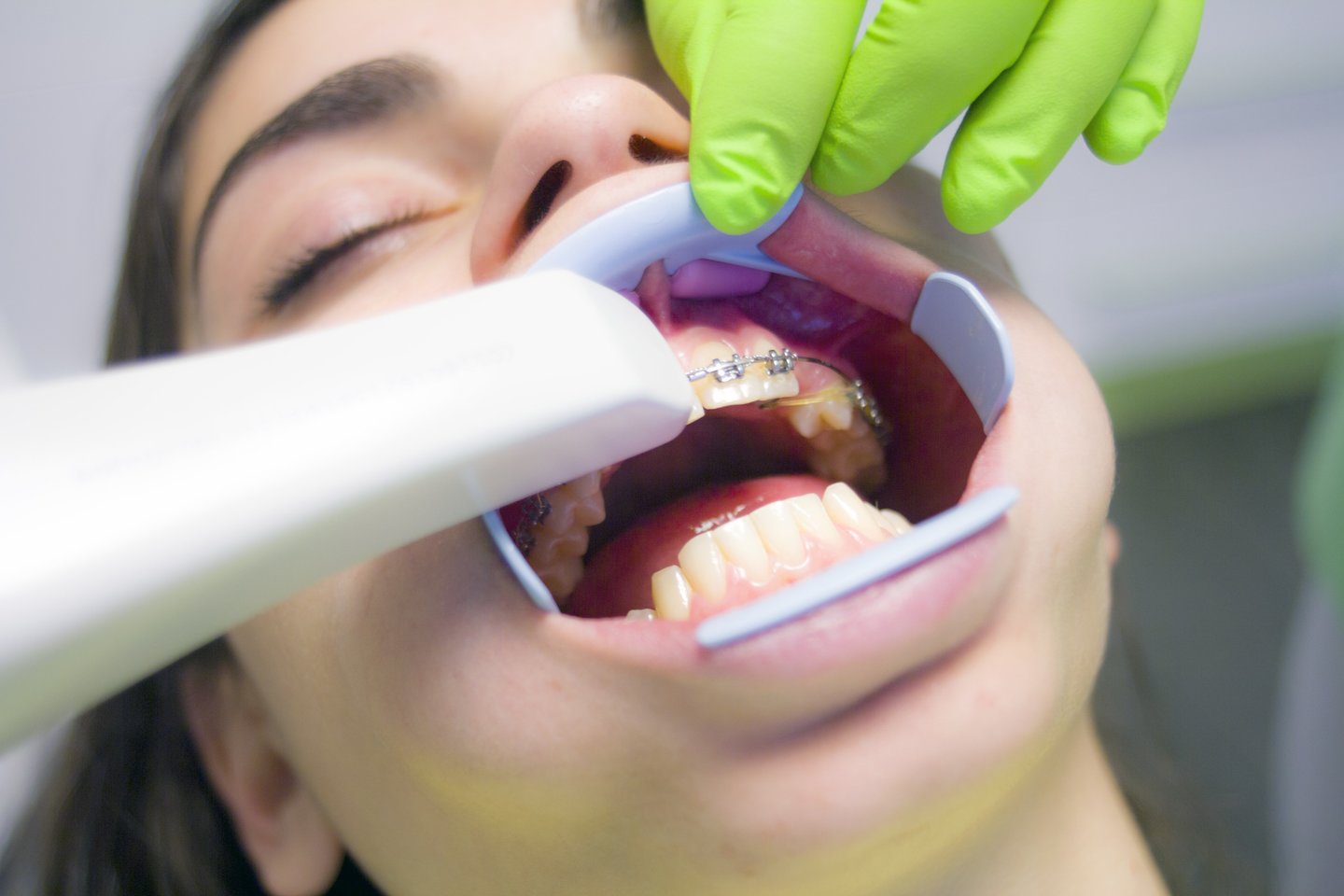 Gydytoja sako, kad, nors ortodontinių anomalijų yra daug, gydymas reikalingas ne visiems.