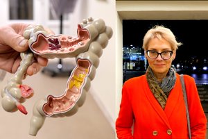 Su storosios žarnos vėžiu susidūrusi vilnietė atskleidė, kaip pavyko suvaldyti ligą