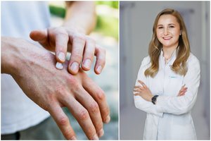 Perspėjo dėl dažnos odos ligos: pasireiškia jauname amžiuje, gali pažeisti sąnarius