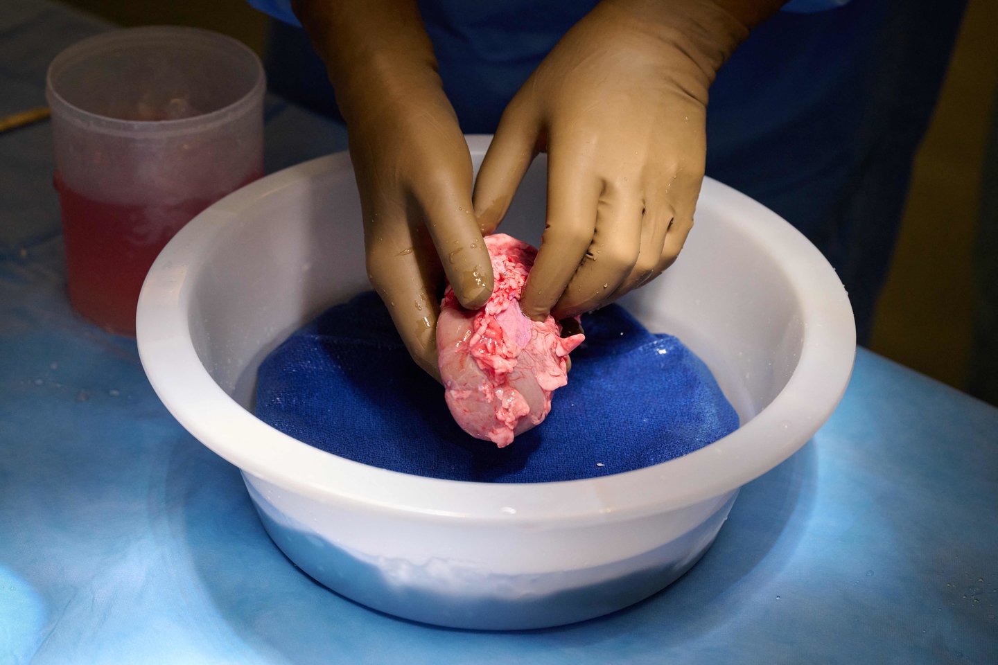  Transplantacijos eksperimente komanda panaudojo genetiškai modifikuotos kiaulės inkstą, kuriame nebuvo šio cukrų gaminančio geno.<br> AFP / Scanpix nuotr.