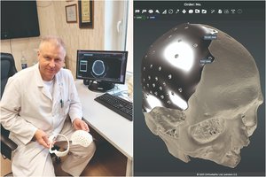 ​Šiaulių medikai kaukolę atkūrė itin moderniu metodu