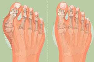 Pėdų ir kelių skausmas priverčia kęsti nemalonumus: atsakė, koks geriausias būdas pajausti palengvėjimą