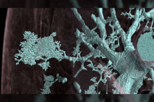 Nauja technologija parodė, kaip COVID-19 iš tiesų pažeidžia plaučius