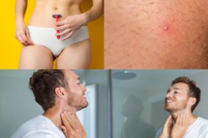 Paprastas sprendimas išgelbės nuo įaugusių plaukelių: išgelbėjo tūkstančius moterų ir vyrų