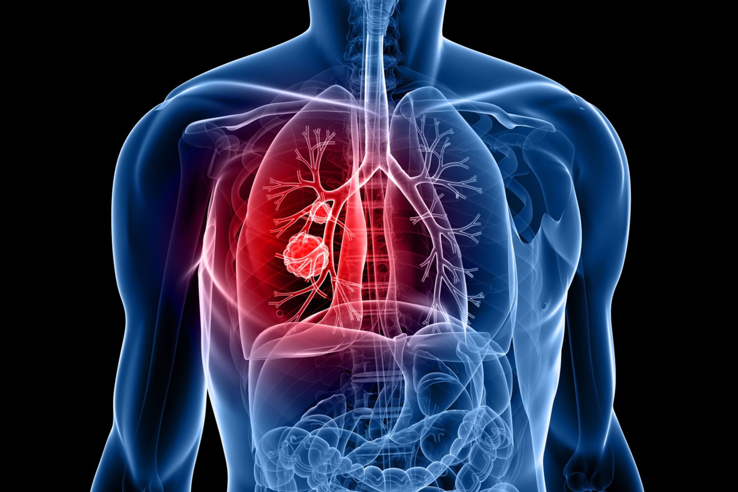 Onkologinė liga, plaučių vėžys<br>123rf nuotr.
