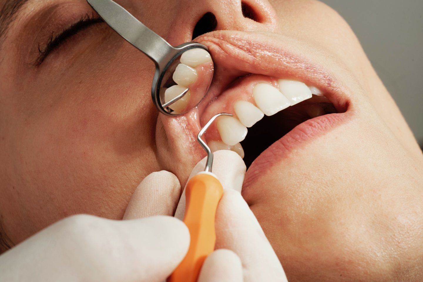 Pakeisti prarastą dantį – įprasta, tačiau ne pigi procedūra.