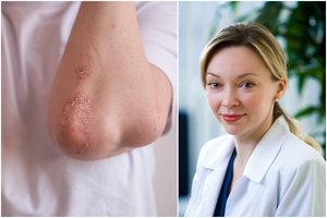 Perspėjo dėl Lietuvoje dažnos odos ligos: visiškai išgydyti nėra kaip